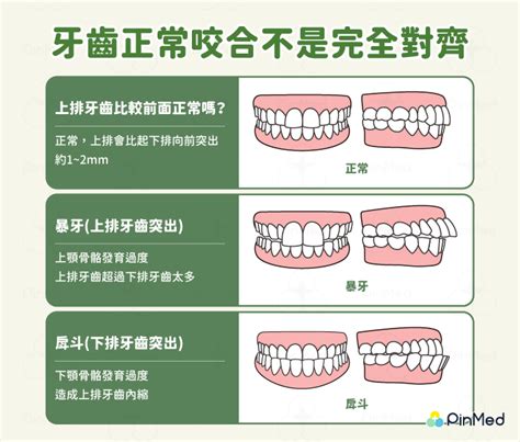 上排牙齒蓋住下排牙齒|牙齒不整齊使你十分沒自信？有「這一些」症狀建議進行牙齒矯。